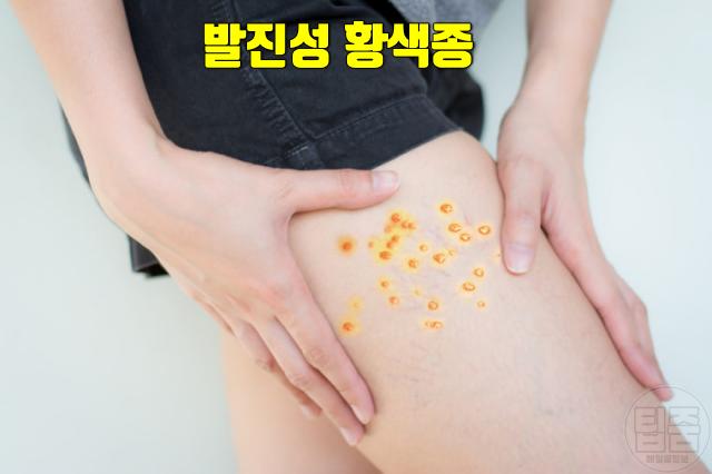 숨은 당뇨병 증상 피부 붉은돌기 뾰루지