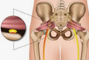 좌골신경통의 원인