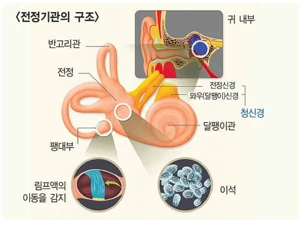 이석증