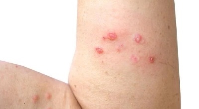 대상포진이미지