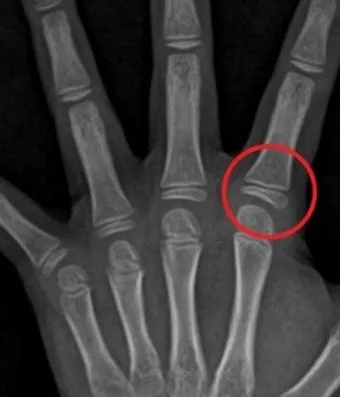 성장판 닫혀도 키 클 수 있는 방법과 성장 호르몬 시기_16