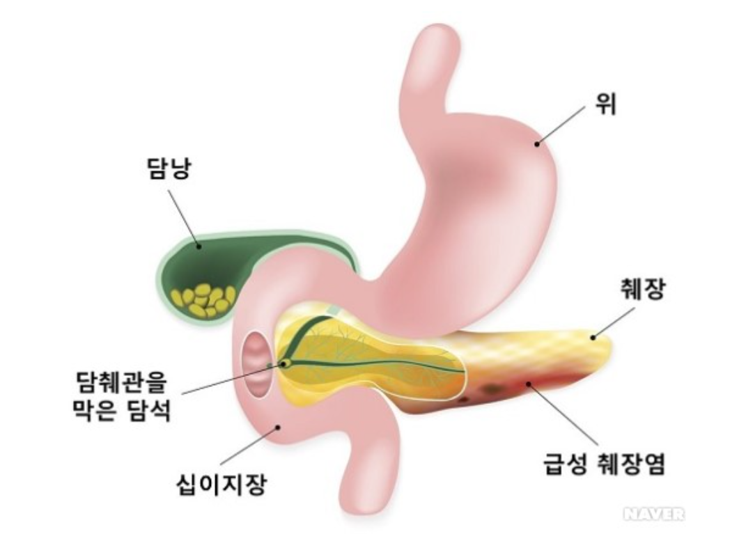 급성췌장염