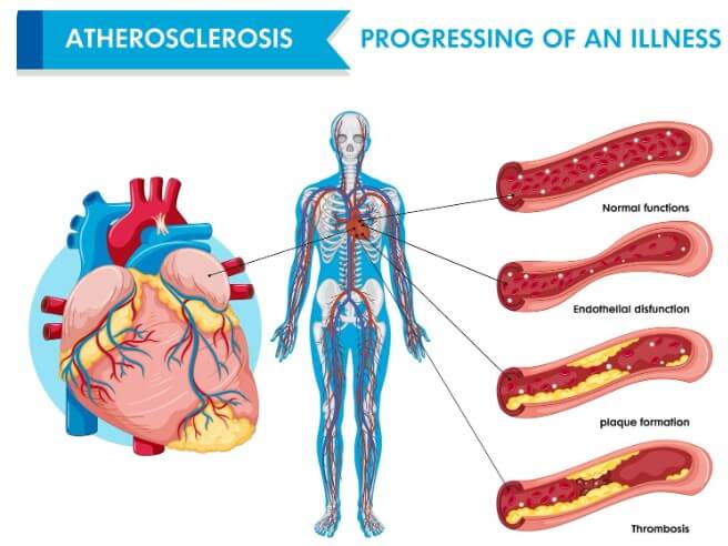 혈관 속 콜레스테롤 수치를 보여주는 모습