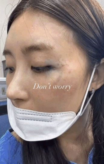 나인뮤지스 현아 낙마사고