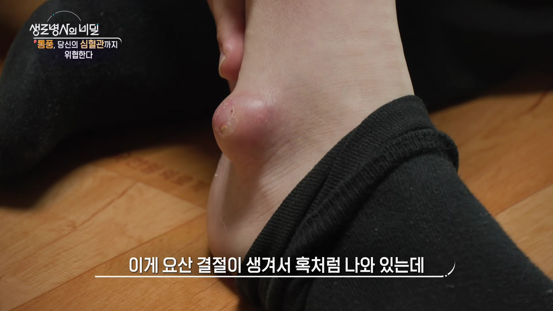 생로병사의 비밀 통풍