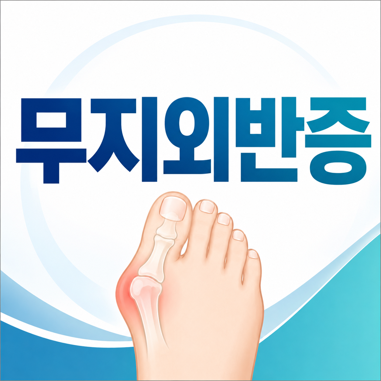무지외반증