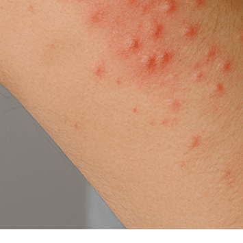 콜린성 두드러기