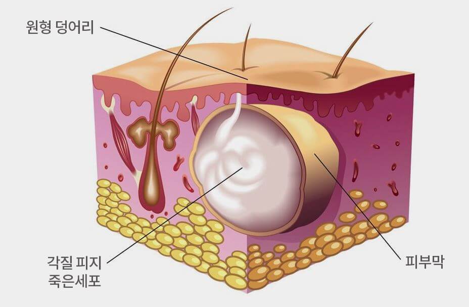 피지낭종이 생겨나는 피부아래 주머니 혹을 보여주는 그림