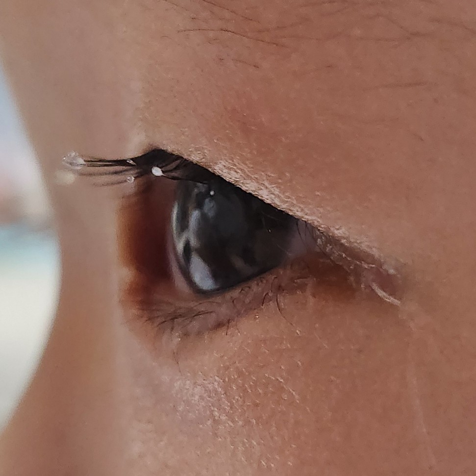 수술 8일 후 눈 옆모습