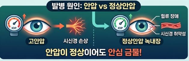 녹내장 초기증상