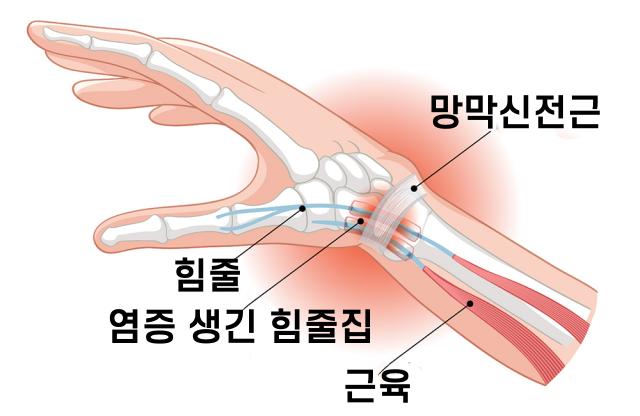 엄지손가락 관절 욱신 통증 자가진단 건초염