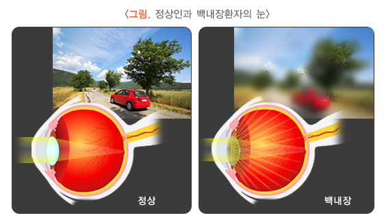 백내장 증상