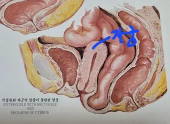 출산 후 자궁수축 기간_23