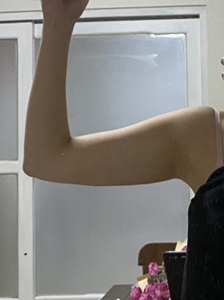 팔뚝 지방분해 주사 후기