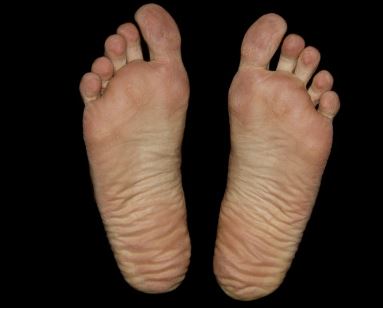 발바닥 가운데 통증