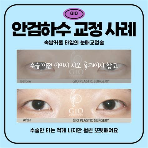안검하수 비용