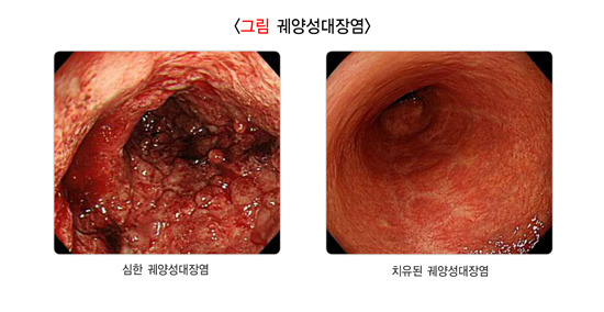 궤양성대장염