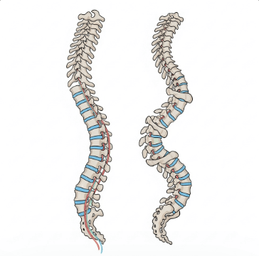 척추 측만증 보조기 착용 가이드1