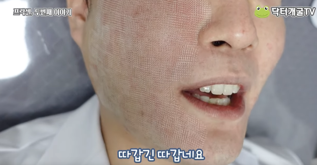 프락셀 시술 후 피부