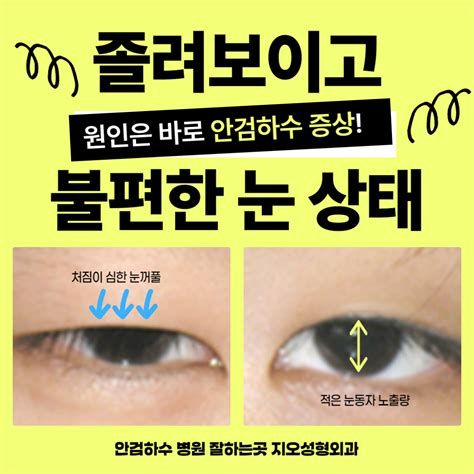 안검하수 비용