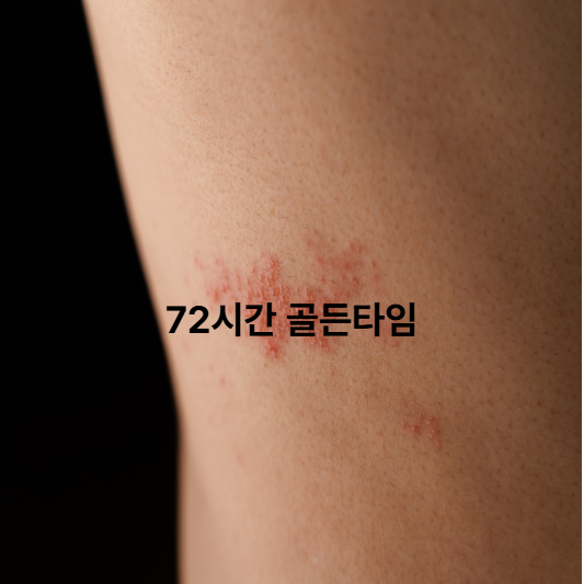 대상포진 신경통 증상과 완화법