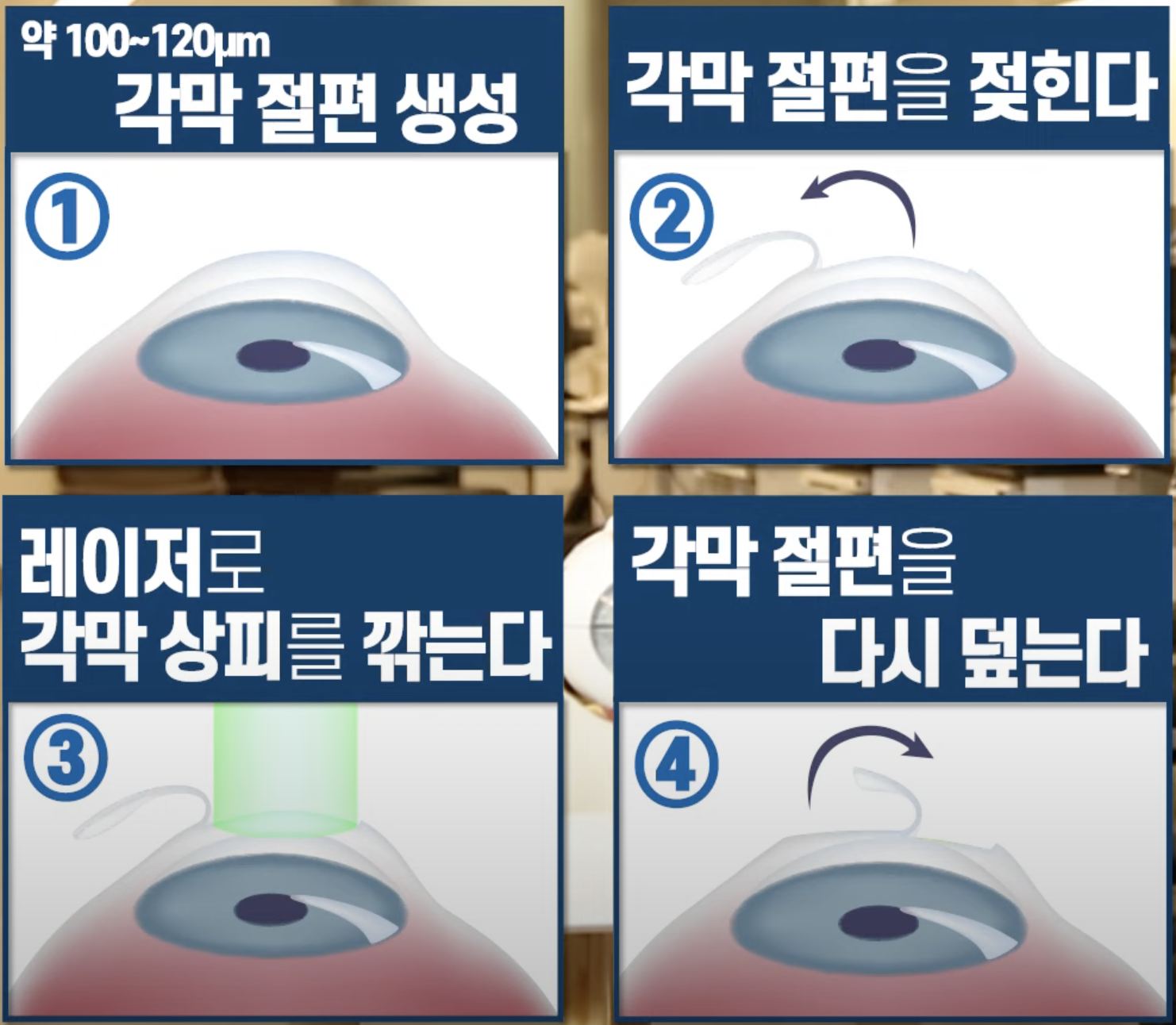시력교정술 종류 라섹 라식 스마일 장단점 비교