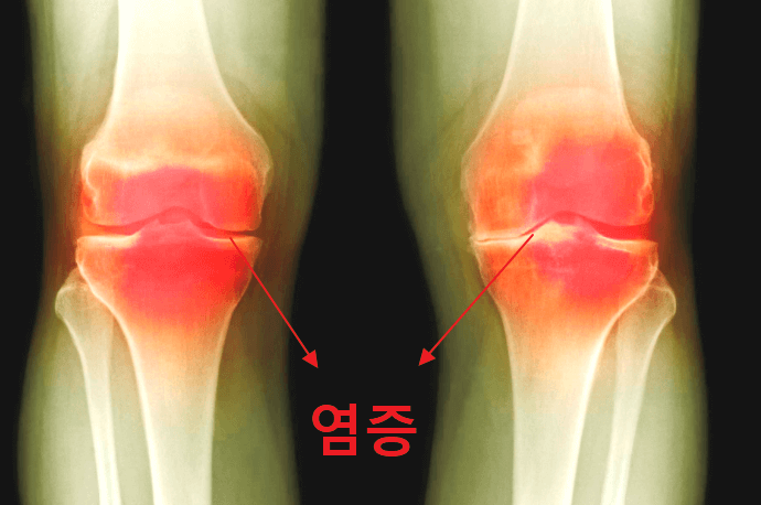 관절염으로 인해 염증이 올라온 사진