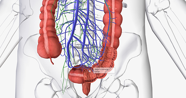 대장암 초기 증상