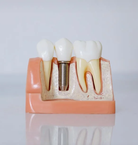 강원 고성군 치과 임플란트 가격 종류 비교