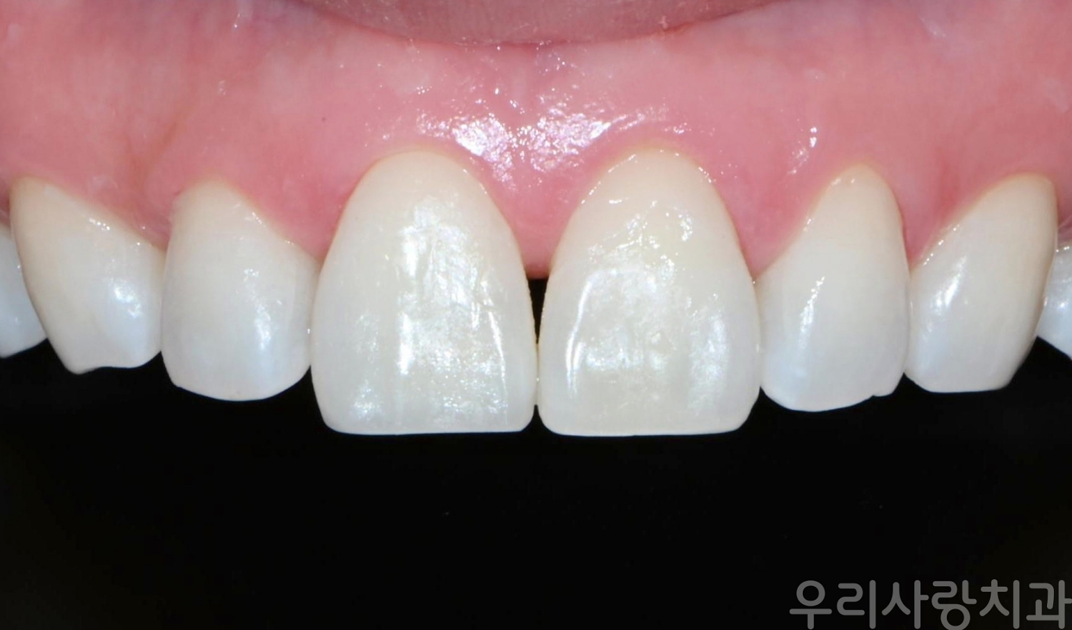 앞니 깨짐 레진 치료 후