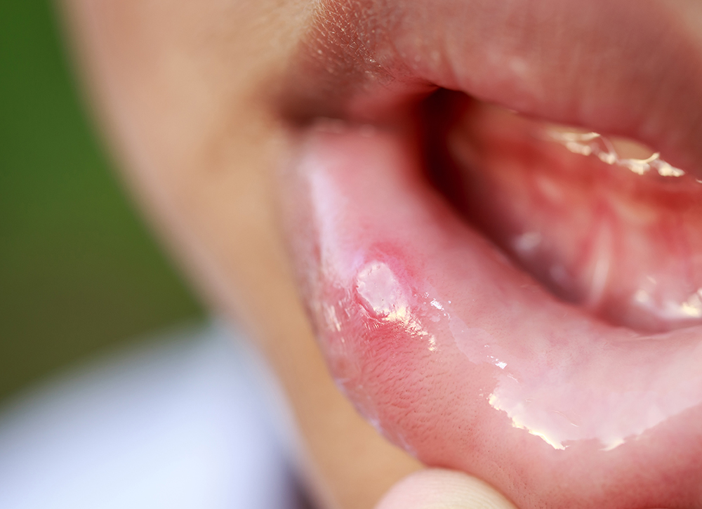 잇몸에 생긴 구내염 클로즈업 사진