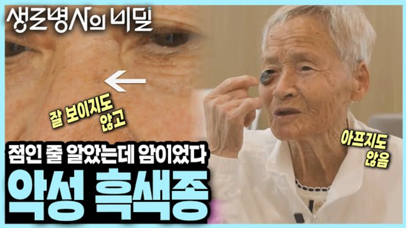 생로 병사의 비밀 악성 흑색종
