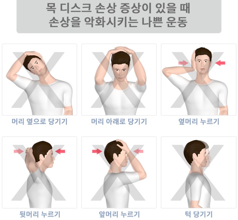 뻐근한 목 통증, 거북목 일자목 증상일까? 목디스크에 좋은 신전동작, 나쁜자세 운동