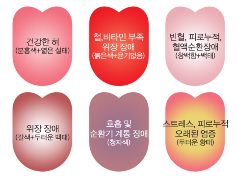 혓바닥 상태