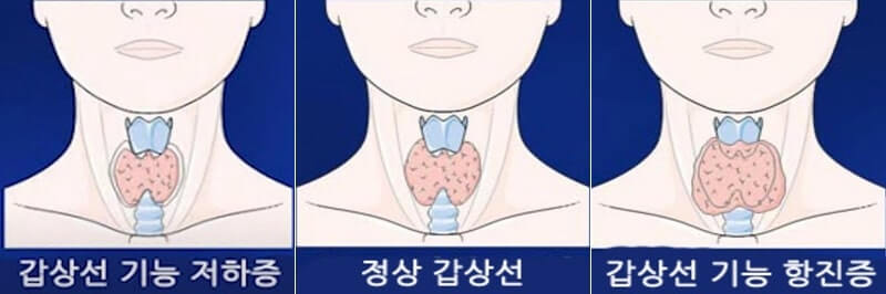갑상선 기능 저하증? 식이조절이 답입니다