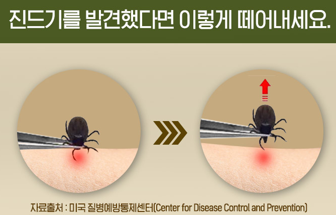 참진드기 물렸을 때 대처 사진
