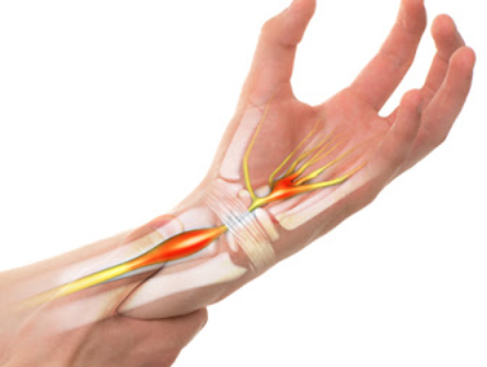 손목터널 증후군