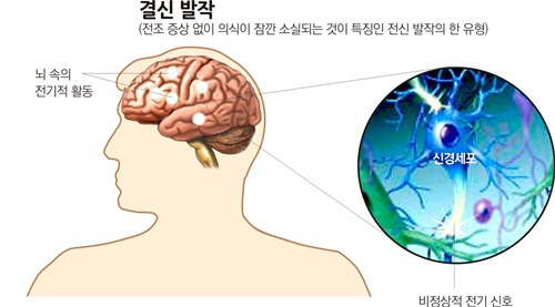 뇌전증 장애등급과 뇌전증 전조증상