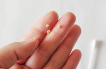 편도결석 빼는법 6가지 집or병원 &amp;#124; 편도결석 원인과 예방법 총정리 