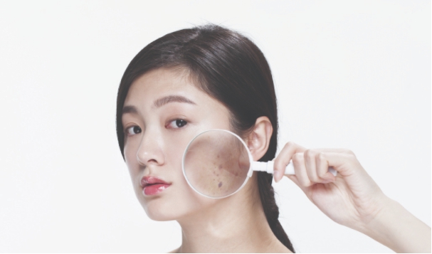 얼굴 검버섯 없애는 방법