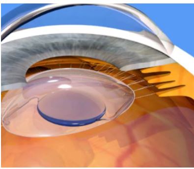 백내장-증상-수술비용