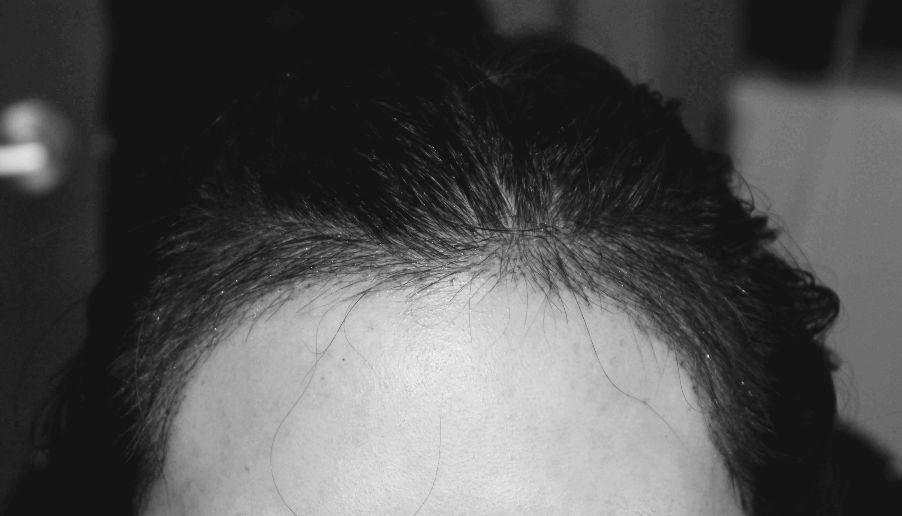 여자 헤어라인 수술 직후