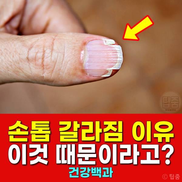 손톱 갈라짐 이유 손톱부러짐