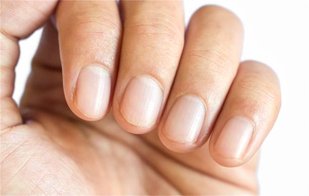 손톱 세로줄과 가로줄 원인이 당뇨와 암일까요? 손톱에 색깔이 변하거나 이상이 생기면 암을 생각할 수 있는데요~ 그 증상들과 관련이 있는지 참고하시기 바랍니다.