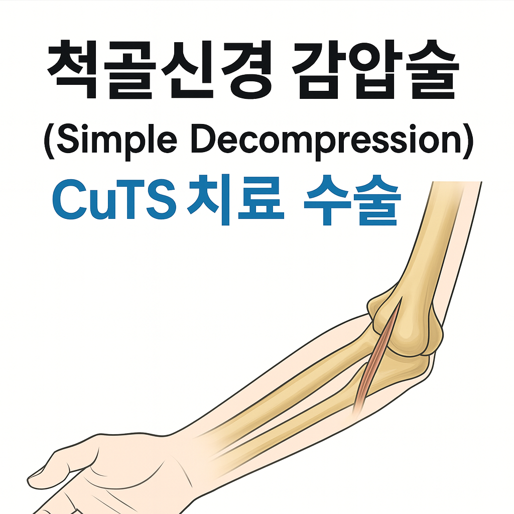 척골신경 감압술 (Simple Decompression) ❘ CuTS 치료 수술