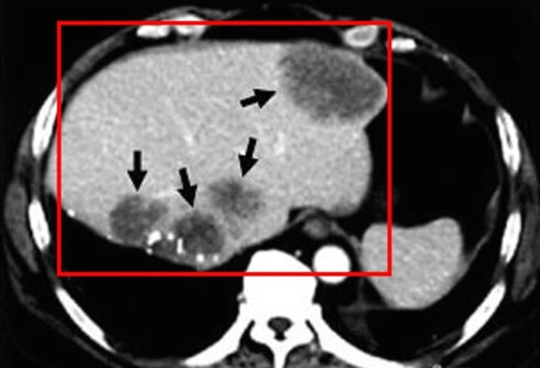 간암 재발 가능성, 재발률