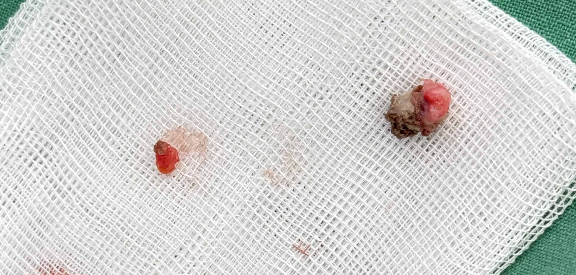 제거한피지낭종