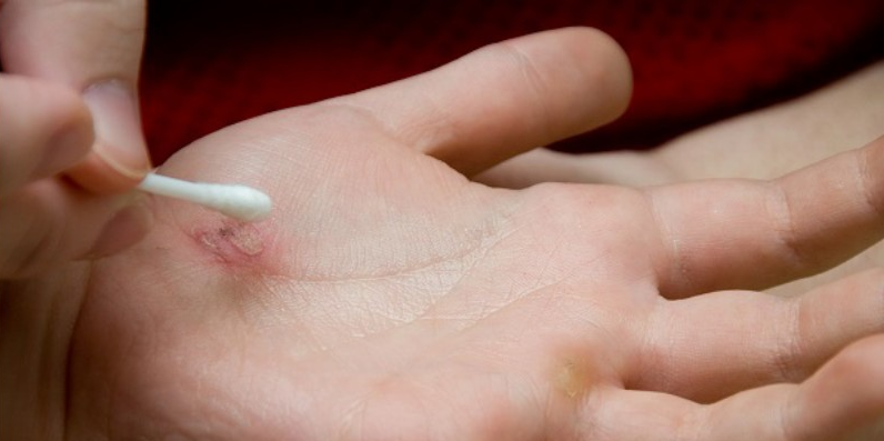 화상-응급처치법