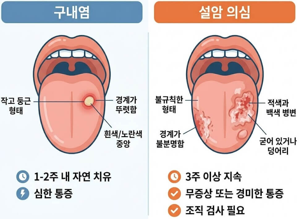 일반 구내염과 설암 의심 병변의 혀 측면 비교 인포그래픽