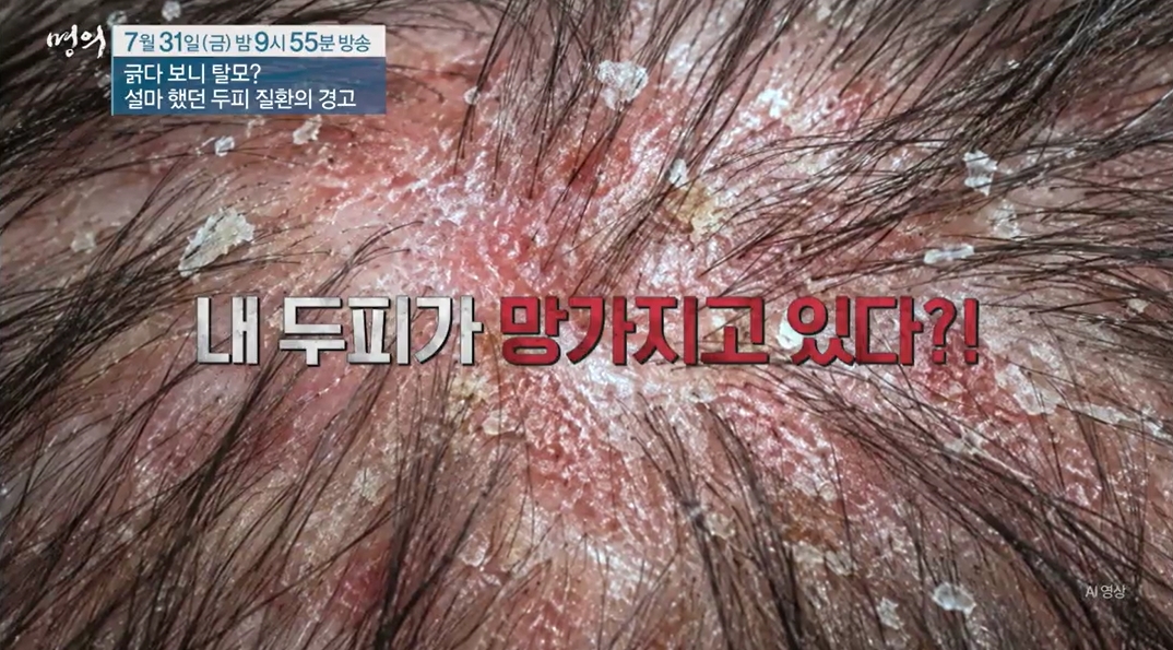 명의 두피질환